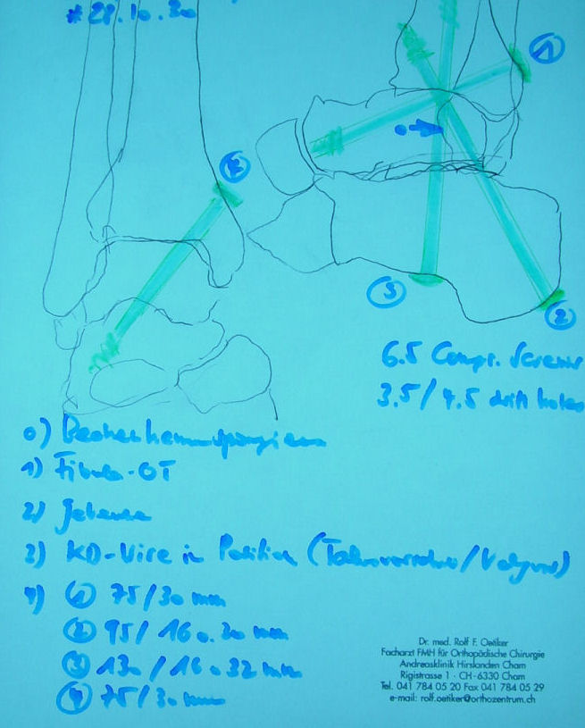 Planungsskizze zur Versteifung des oberen und unteren Sprunggelenks